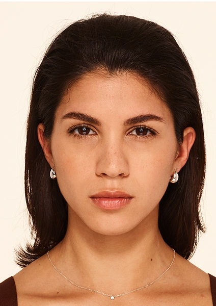 Botox forehead lines, frown lines, crow's feet lines after - Nicole