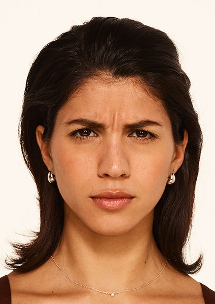 Botox forehead lines, frown lines, crow's feet lines before - Nicole